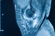 OSSIO推出更小、更强、更智能的生物整合缝线锚钉,用于骨科手术