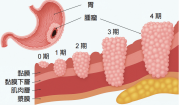 生物标记在胃癌治疗中的应用