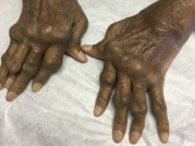 SetPoint Medical完成1.4亿美元融资,推进类风湿关节炎疗法