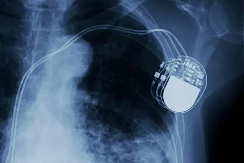 An x-ray of a pacemaker