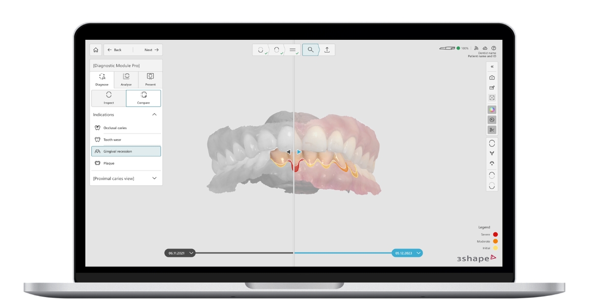 FDA批准3Shape Dx软件用于牙科诊断